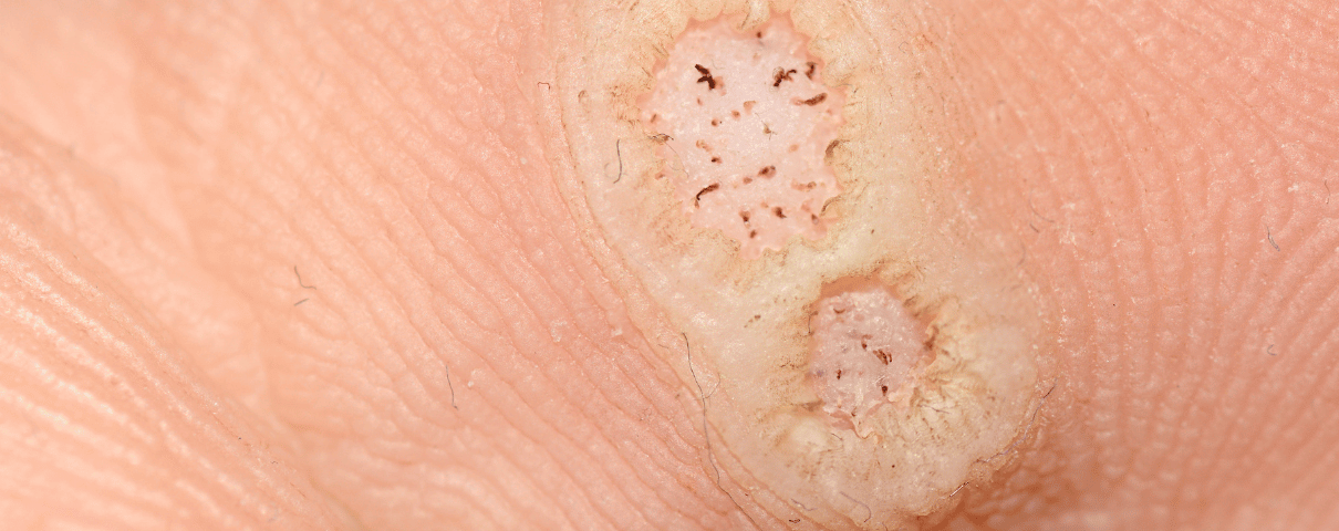 Wirus brodawczaka ludzkiego i widoczne zmiany skórne