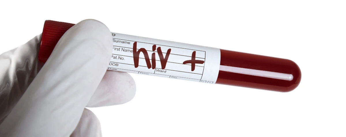 Wynik pozytywny testu na HIV w probówce