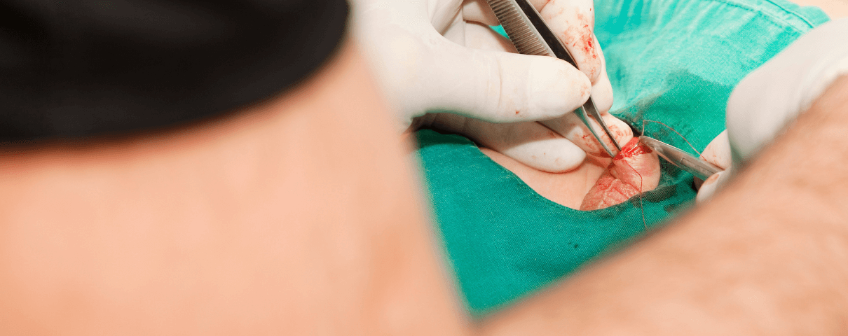 Operacja obrzezania penisa